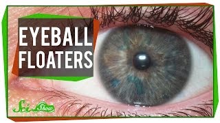 Those Maddening Eyeball Floaters [upl. by Eleazar]