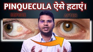 How To Remove Pinquecula सबसे आसान उपाय Lokesh Dixit [upl. by O'Conner184]