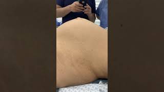 Diastasis de rectos y hernia umbilical antes de la cirugía [upl. by Laekcim]