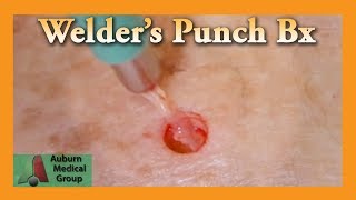 Welders Punch Biopsy  Auburn Medical Group [upl. by Blus421]