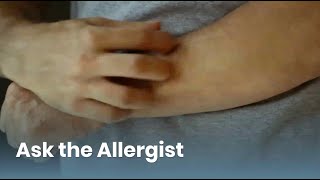 Chronic Hives Triggers and Treatment Ask the Allergist Chronic Urticaria [upl. by Oigres886]