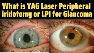 Peripheral Iridotomy  Lpi Eye Procedure  Yag Pi Laser  Lpi Eye Surgery  Glaucoma Treatment [upl. by Chelsie]