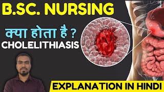 CHOLELITHIASIS COMPELTE EXPLANATION IN HINDI ONE SHOT GNM BSc NURSING LECTURE 2024 BHUSHAN SCIENCE [upl. by Ardnuhsed]