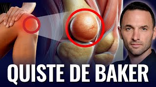 QUISTE DE BAKER  Dolor de rodilla  Causas  Síntomas  Tratamientos [upl. by Epperson]