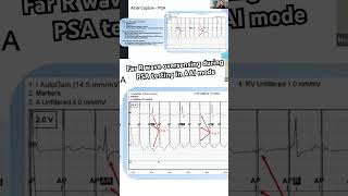 Pacemaker bites Far R during PSA testing at implant cardiology cardiacelectrophysiology [upl. by Eiveneg]