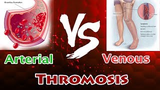 Arterial Thrombosis Vs Venous Thrombosis  Clear Comparison [upl. by Hollington]