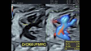 Fetal Echo  Tetralogy of Fallot [upl. by Fotinas]