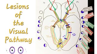 Lesions of the Visual Pathway  Optic Nerve and pathway lesions [upl. by Riella]