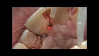 PHILIPS LASERS Eviction gingivale multiple 3wmv [upl. by Sigvard]