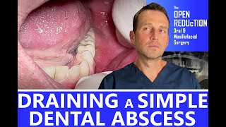 DRAINING a SIMPLE DENTAL ABSCESS [upl. by Adniroc]