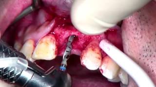 Step by Step Anterior Implant placement with GBR with voiceover [upl. by Talanian]