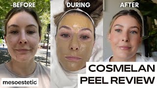 COSMELAN DEPIGMENTATION PEEL  chemical peel for pigmentation  dark spots [upl. by Rust71]