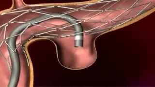 Endovascular Coiling for Brain Aneurysm [upl. by Just]