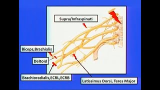 Brachial Plexus Injuries [upl. by Bhayani]