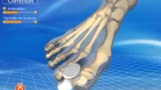 Hallux Valgus Correctores Orliman [upl. by Nelhsa]