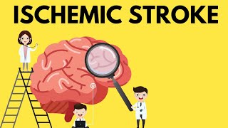 The Essential Guide to Ischemic Stroke [upl. by Eixor]