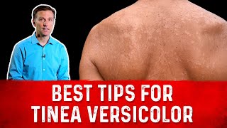 Best Tips for Tinea Versicolor Treatment Skin Fungus – Dr Berg [upl. by Eimma]