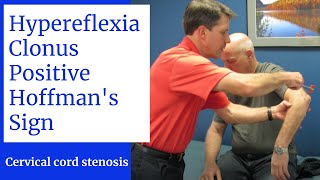 Hyperreflexia Clonus Positive Hoffmans Sign Central Cervical Spine Stenosis [upl. by Otilesoj]