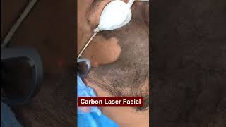 Carbon Laser Treatment Will Make You Tons Of Cash Heres How carbon Carbonlaserfacial shorts [upl. by Allecram]