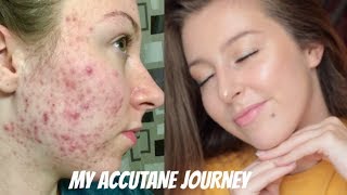 MY ISOTRETINOIN ACCUTANE JOURNEY  BEFORE AND AFTER PHOTOS [upl. by Ayekam38]