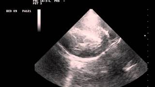 cardiomegaly and hypertrophy due to an adrenal pheochromocytomaavi [upl. by Ahsin]