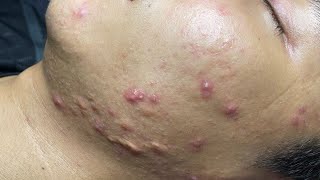 ACNE TREATMENT VU QUYNH MI Blackheads On Boy Face 2024 [upl. by Frohman]