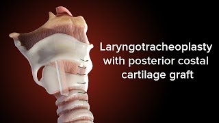 Medical Animation Posterior Cricoid Split  Cincinnati Childrens [upl. by Sulienroc]