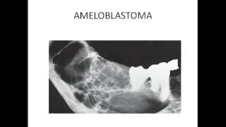 Maxillofacial radiology  MULTILOCULAR RADIOLUCENCY OF JAW [upl. by Mabel]