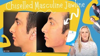 How To Get A Chiselled Masculine Jawline  Radiesse [upl. by Largent641]