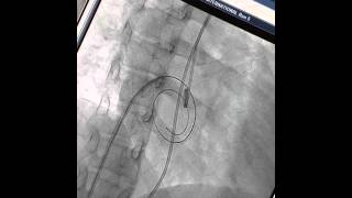 How to do a Percutaneous Transvenous Mitral Commissurotomy PTMC Dr Binoy John COMPLETE STEPS [upl. by Llehsar]