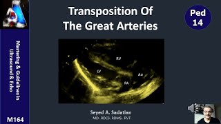 Congenitally Corrected Transposition of the Great Arteries [upl. by Llyrad]