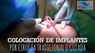 Colocación de implantes dentales [upl. by Irpak117]