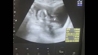 Bicornuate uterus 14wks pregnancy Diagnostic ultrasound cases [upl. by Adnilemre]