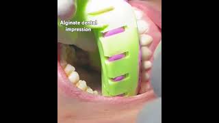 Alginate dental impression [upl. by Anihsak]