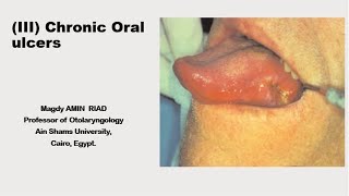 III Chronic Oral Ulcers [upl. by Eremahs399]