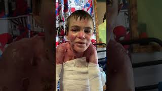 Marky was born with epidermolysis bullosa recessive dystrophic explore trending explorepage [upl. by Essile]