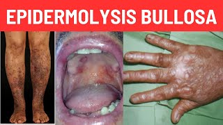 What is Epidermolysis Bullosa Causes Symptoms [upl. by Lemrahs]