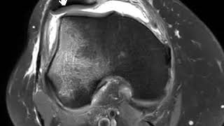 Transient patellar dislocation of knee [upl. by Tat93]