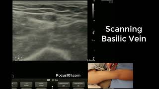 Scanning the Basilic Vein with Ultrasound [upl. by Jeaz174]