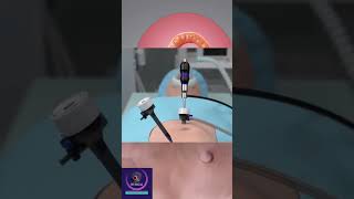 Inguinal Hernia Repair  Medical Surgery [upl. by Pyle]