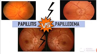 PAPILLITIS vs PAPILLEDEMA [upl. by Fredericka]