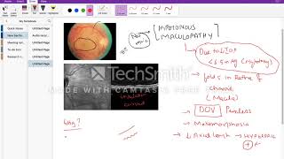 Hypotonous maculopathy [upl. by Radbourne]