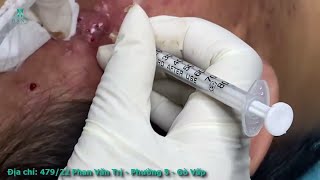 Big Cystic Acne Blackheads Extraction Blackheads amp Milia Whiteheads Removal Pimple Popping [upl. by Spain]