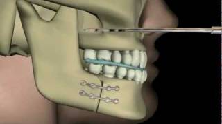 Çift Çene AmeliyatıUpper and Lower Jaw Surgery [upl. by Delainey]