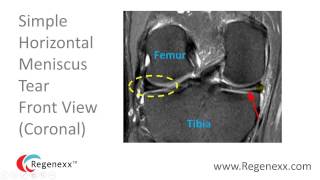 How to Read a Knee MRI for Meniscus Tears [upl. by Munford]