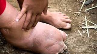 The worms inflating your limbs The battle to eliminate elephantiasis [upl. by Ellerd]