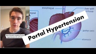 COMPLICATIONS of Portal Hypertension EXPLAINED [upl. by Eiramana]