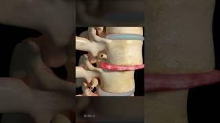 Intervertebral Disc Replacement 3D Animation [upl. by Suirtemed225]