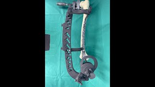 2023 NCB JOY  minimal invasive amp polyaxial targeting device for periprosthetic distal femur plate [upl. by Dublin]