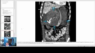 Hepatic Adenoma Imaging [upl. by Ocker]